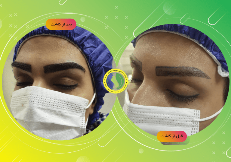 بهترین کلینیک کاشت ابرو در تهران