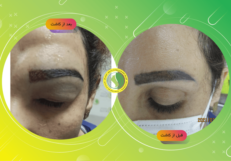 بهترین کلینیک کاشت ابرو در تهران