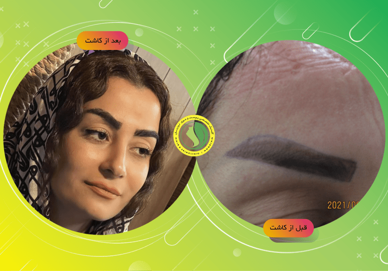 بهترین کلینیک کاشت ابرو در تهران