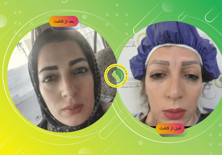 بهترین کلینیک کاشت ابرو در تهران