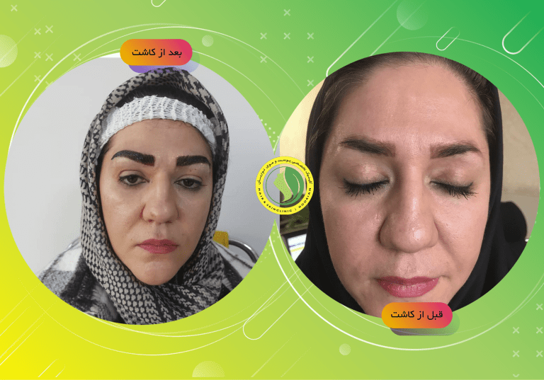 بهترین کلینیک کاشت ابرو در تهران