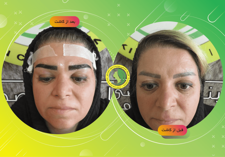 بهترین کلینیک کاشت ابرو در تهران