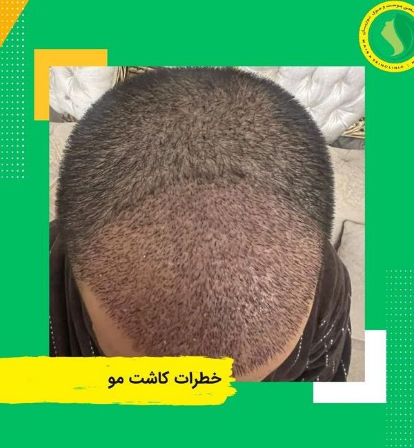 خطرات کاشت مو - بهترین کلینیک کاشت مو در تهران
