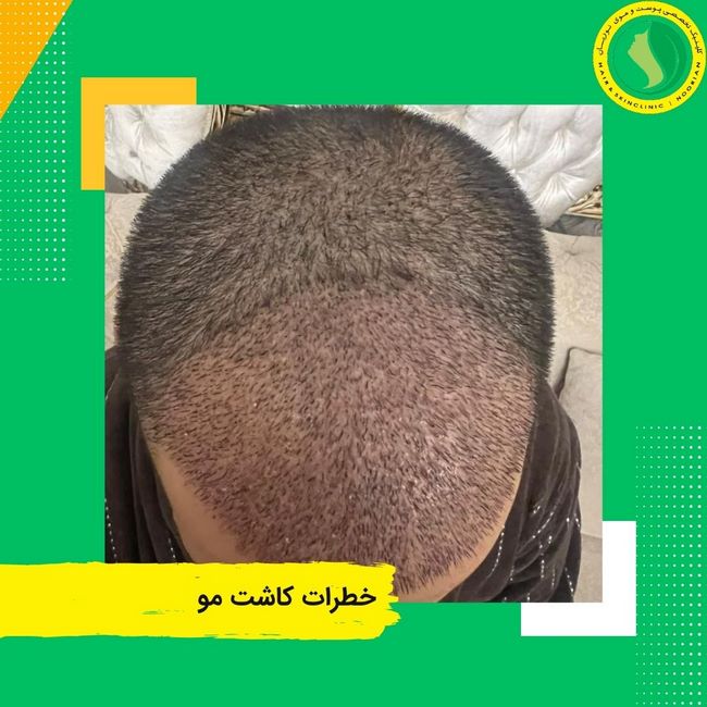 خطرات کاشت مو - بهترین کلینیک کاشت مو در تهران