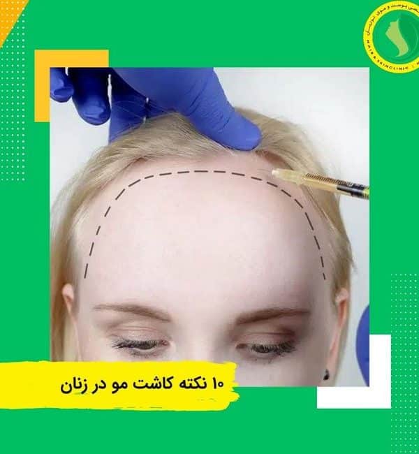 ۱۰ نکته و راهکار برای کاشت مو در زنان