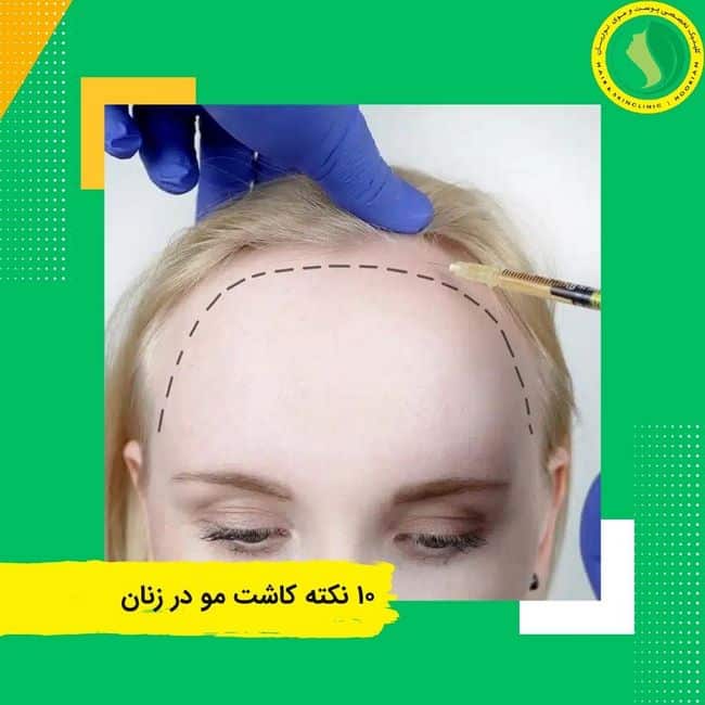 ۱۰ نکته و راهکار برای کاشت مو در زنان